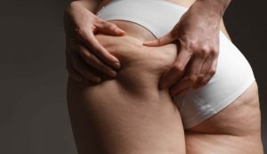 cellulite come combattere